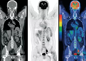 La magia del PET:  tomografía de emisión de positrones para descubrir tumores cancerosos