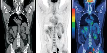 La magia del PET:  tomografía de emisión de positrones para descubrir tumores cancerosos