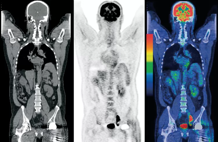 La magia del PET:  tomografía de emisión de positrones para descubrir tumores cancerosos