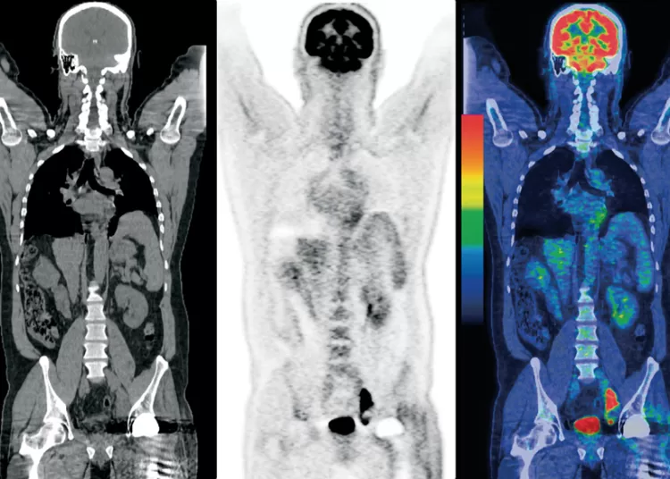 La magia del PET: tomografía de emisión de positrones para descubrir tumores cancerosos